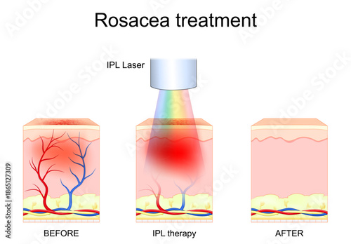 IPL therapy. Rosacea treatment. Skin before and after Intense pulsed light procedure