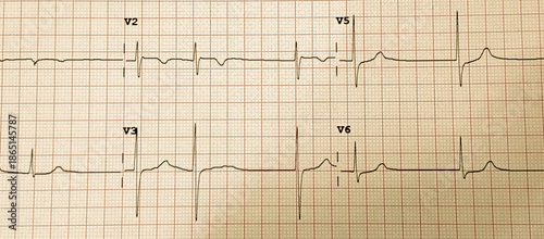 Fotografia electrocardiogram demonstrating ventricular paced rhythm with pacemaker spikes before wide qrs complexes