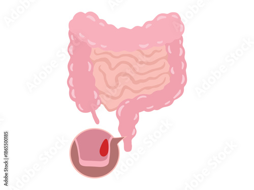 Hemorrhoids Disease Clip Art Illustration
