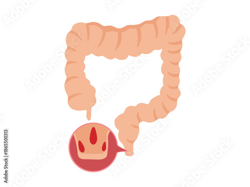 Hand Drawn Hemorrhoids Disease in Intestine
