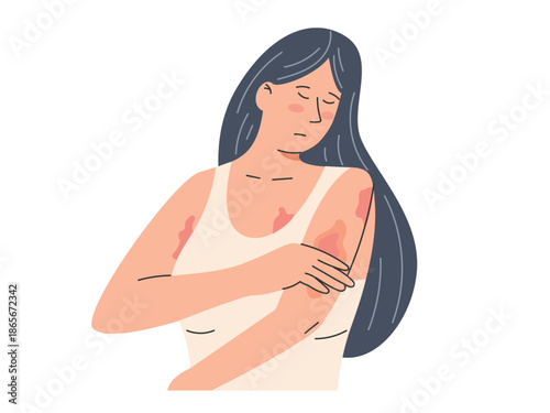 Woman looking eczema on body for dermatology, scratching arm, red rash skin irritation