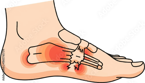 Diagram illustrating pain points in the plantar aspect of a human foot