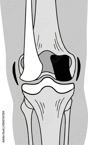 Detailed illustration of a human knee joint's anatomy with distinct bone structures and cartilage