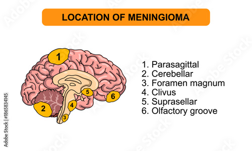 location of meningioma in the brain. Tumors in the brain membrane and spinal cord. Inflammation of meninges. Vector illustrations for medical, posters, health and education.