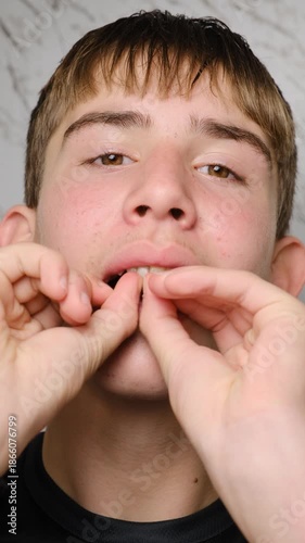 Vertical video shows a young male independently fixing a removable partial butterfly dental prosthesis into the upper jaw. Use of a temporary dental prosthesis. Age restriction for dental implants.