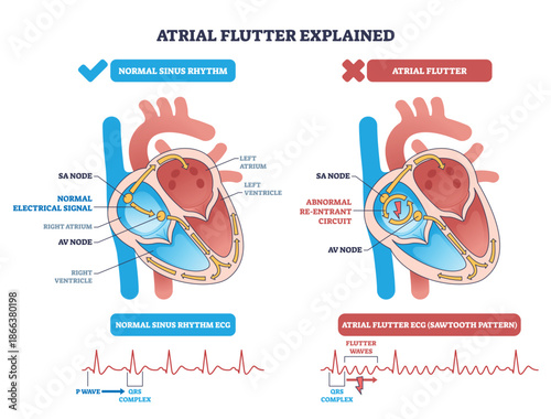 Atrial flutter explained diagram contrasts normal rhythm with re-entrant circuit in the heart, highlighting SA node, AV node, and sawtooth ECG pattern for clarity. Outline diagram