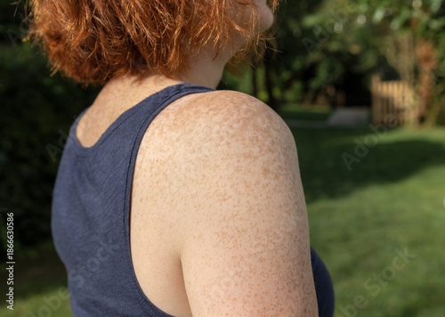 Freckled upper arm and shoulder of fair-skinned red-haired woman standing outdoors