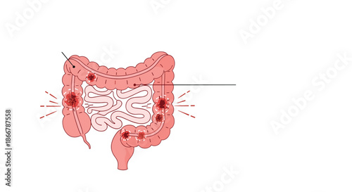 Medical vector illustration of the human large intestine showing inflammation, polyps, or signs of colorectal cancer disease.