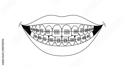 Black and white line drawing of a smiling mouth showing a full set of teeth with orthodontic metal braces installed.