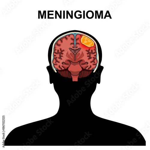 Illustration of meningioma. Tumor, cancer in the human brain. Illustration of brain disease. Vector nerve illustration for medical concept, poster, diagram, science or health element infographic