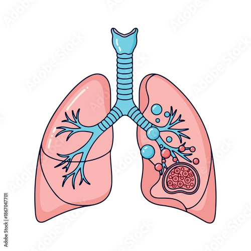 Illustration of human lungs with trachea and bronchi, highlighting a healthy left lung and a diseased right lung with a tumor.