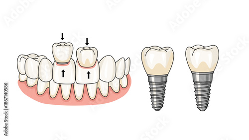 Medical illustration showing the process of dental implant surgery with replacement teeth being fitted into the human jaw.