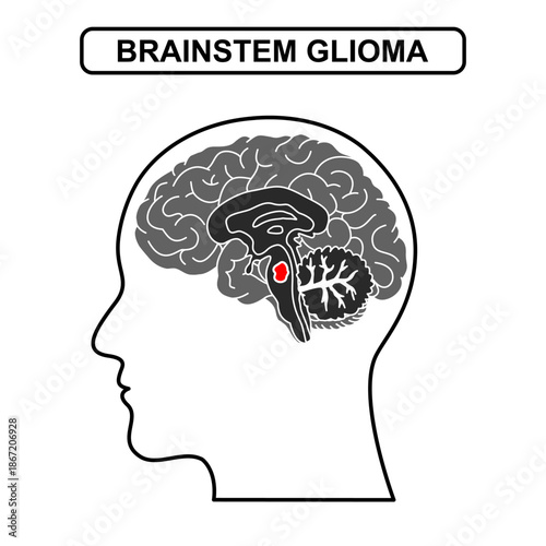 Illustration of Brainstem glioma. Tumor, cancer in the human brain. Illustration of brain disease. Vector nerve illustration for medical concept, poster, diagram, science or health element infographic
