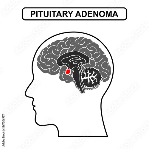 Illustration of pituitary adenoma. Tumor, cancer in the human brain. Illustration of brain disease. Vector nerve illustration for medical concept, poster, diagram, science, health element infographic