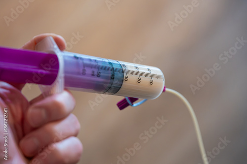Fotografija Medical syringe with tube feeding consisting of special milk for children who cannot eat