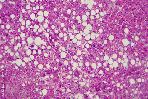 Hepatic steatosis, light micrograph