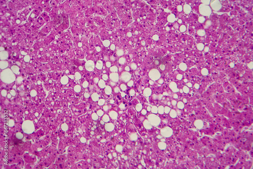 Hepatic steatosis, light micrograph