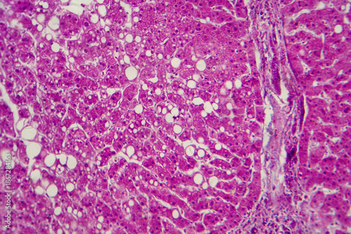 Hepatic steatosis, light micrograph
