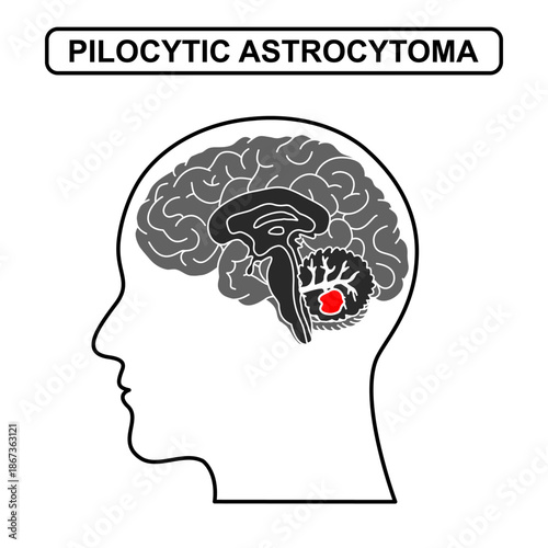Illustration of pilocytic astrocytoma. Tumor, cancer in the human brain. Illustration of brain disease. Vector nerve illustration for medical concept, poster, diagram, science or health element.