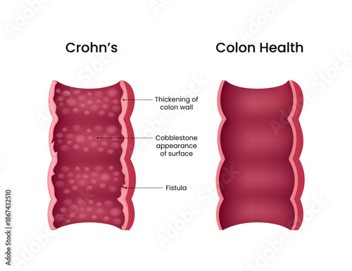 Crohn's Disease vs Healthy Colon A Visual Comparison