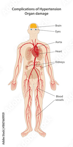 Complications of Hypertension. Medical illustration showing the human body and target organs. Vector illustration in a flat style isolated over white background