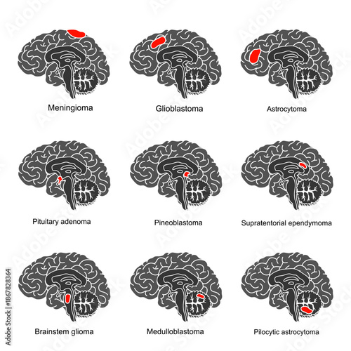 Primary brain tumors illustration. Glioblastoma, meningioma, pituitary and pineoblastoma. Cancer in cerebellum medulloblastoma and pilocytic astrocytoma. Vector illustration for medical and edication