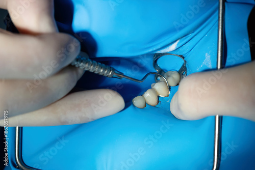 Fotografía Close up of dentist hands shaping dental composite filling using precision hand instrument