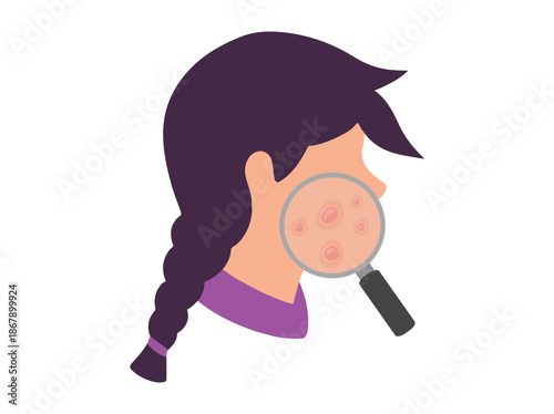 Acne Nodule in Face Skin