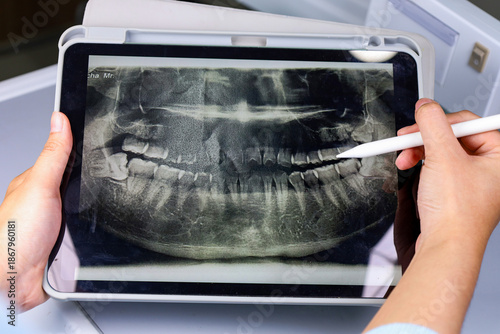 Dentist pointing at a digital panoramic X-ray on a tablet screen, highlighting an impacted wisdom tooth.