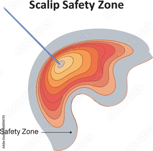 Medical of scalp safety zone with contour lines and needle insertion