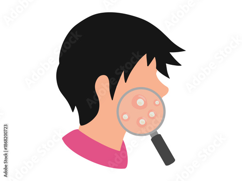 Acne Whitehead in Face Skin
