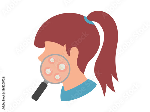 Acne Whitehead in Face Skin
