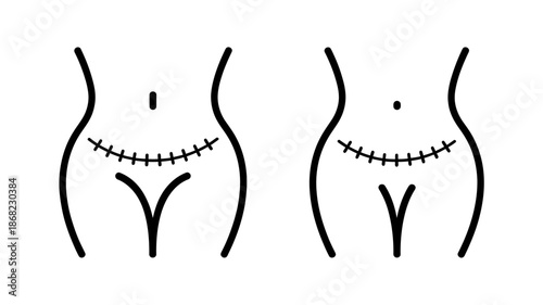 Illustration of a woman's lower abdomen with a c-section scar, representing surgical recovery