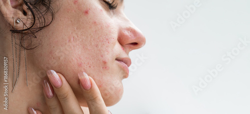 portrait of teen girl with pimples and acne on problematic facial skin. Face of young female with bad red inflamed skin and acne in close-up on a white isolated background