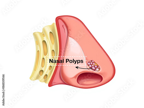 Nasal polyps shown in cross section of human nose with turbinates image