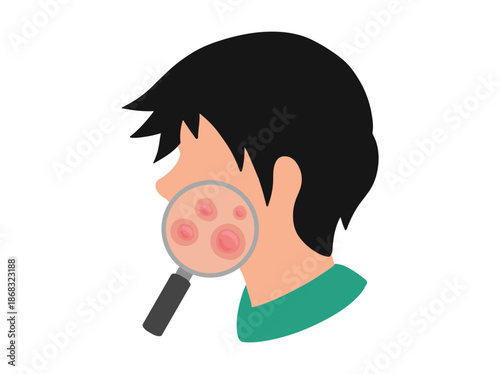 Hand Drawn Acne Papula in Face Skin Clip Art
