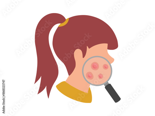 Acne Papula in Face Skin
