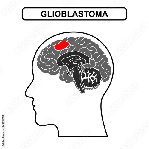 Illustration of glioblastoma . Tumor, cancer in the human brain. Illustration of brain disease. Vector nerve illustration for medical concept, poster, diagram, science or health element infographic