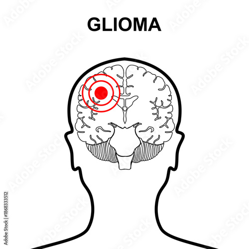 Illustration of glioma tumor, cancer in the human brain. Headache, Inflammation. Vector illustration for posters, oncology clinics, education, and health elements.