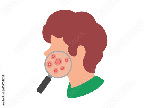 Acne Cystic in Face Skin Illustration

