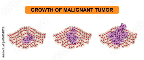 Vector illustration of malignant tumor growth. The development of cancer cells, tumors, spread. Medical diagram illustration for poster, education, science and health elements.