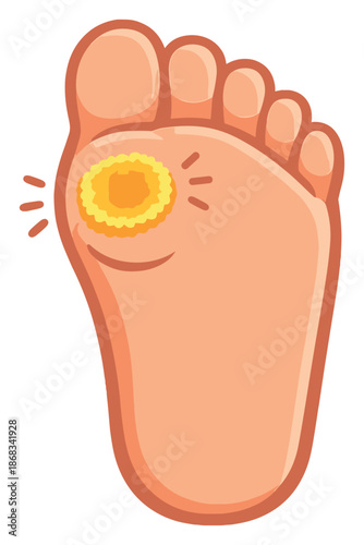 Illustration of a foot with a painful callus highlighted in red