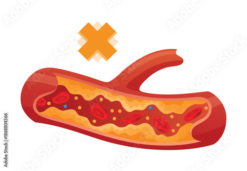 Type of cholesterol in human blood vessels. Narrowed artery for explanation diseases. Low-Density Lipoprotein LDL . Vector illustration