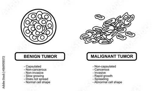 Vector illustrations of malignant and benign tumors in body tissues. Spread of cancer cells. Medical vector illustrations for education, posters, clinics, and science.