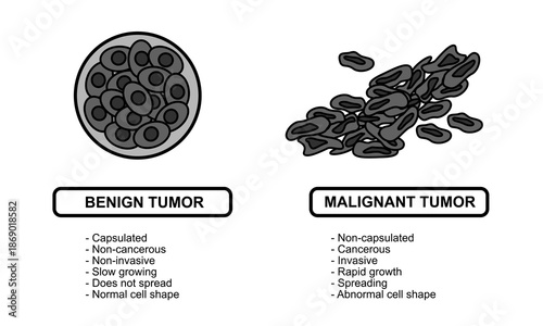 Vector illustrations of malignant and benign tumors in body tissues. Spread of cancer cells. Medical vector illustrations for education, posters, clinics, and science.