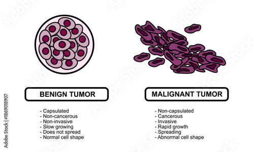 Vector illustrations of malignant and benign tumors in body tissues. Spread of cancer cells. Medical vector illustrations for education, posters, clinics, and science.
