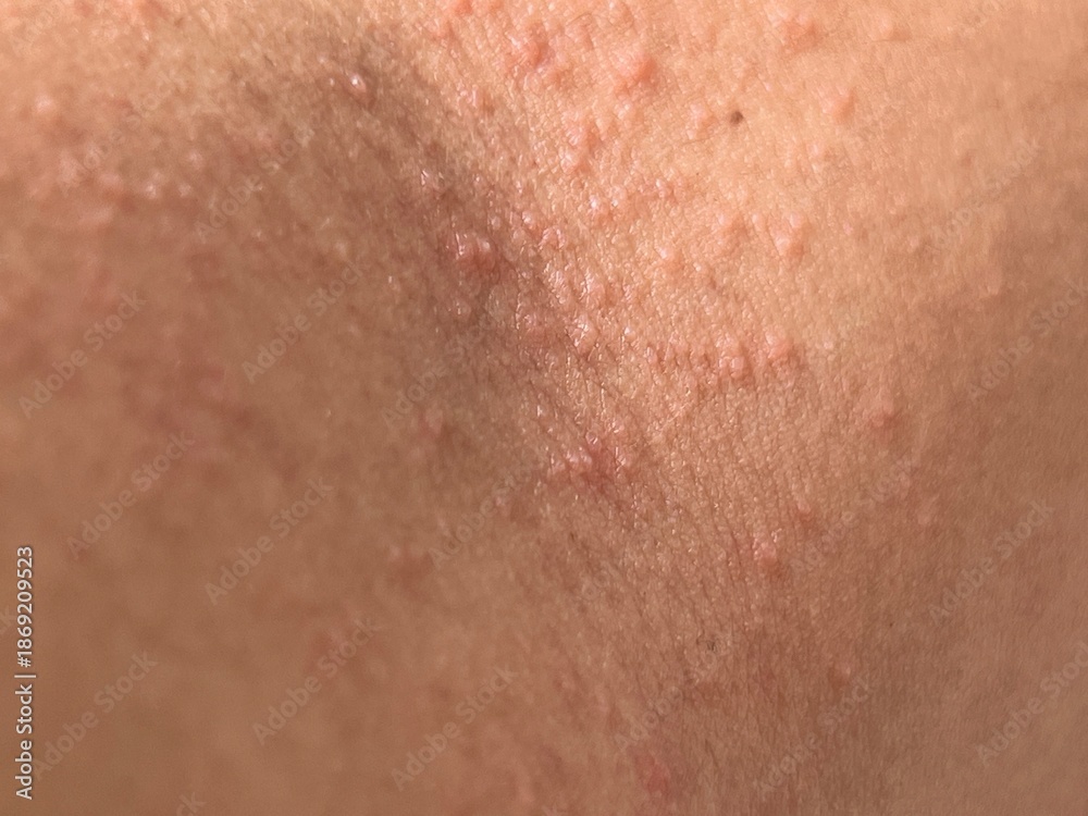 Fototapeta premium Detailed close-up of human skin showing clusters of small raised red bumps. The uneven texture highlights dermatological detail, relevant for medical, skincare, or health-related themes.
