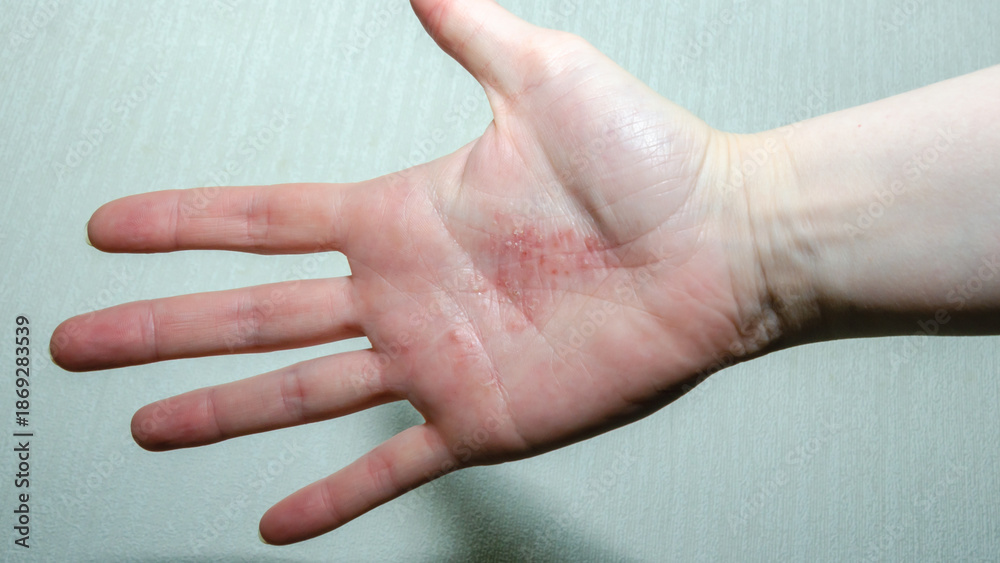 Fototapeta premium Female palm showing dyshidrotic eczema with small red itchy blisters and dry skin, close-up view of hand dermatitis symptoms. Clinical dermatological, skin issues and treatment