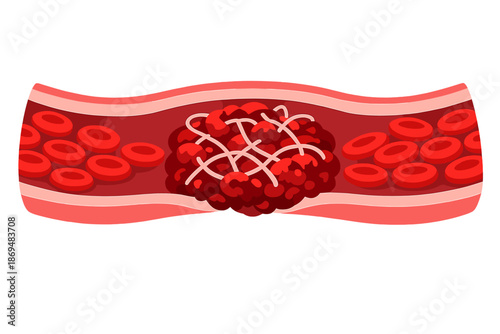 Depiction of a blood clot obstructing the flow of red blood cells