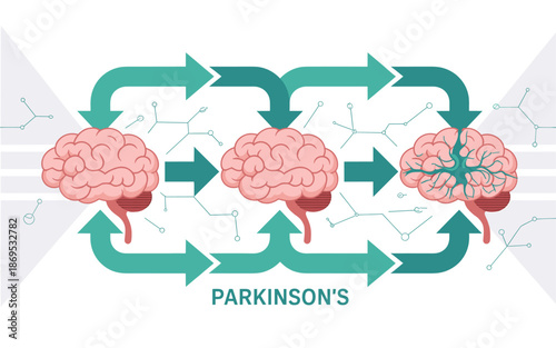 Parkinson's disease progression illustration with brain changes